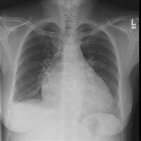 Cardiomégalie radiographie thoracique | FyzGY