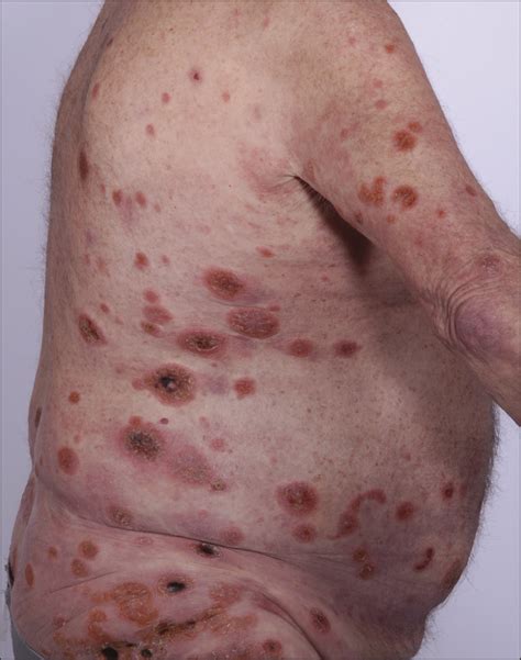 Fatal Cytotoxic Cutaneous Lymphoma Presenting as Ulcerative Psoriasis | Dermatology | JAMA ...