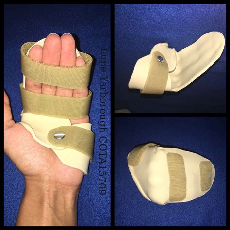 Static dorsal blocking orthosis | Hand therapy, Orthosis, Occupational therapy