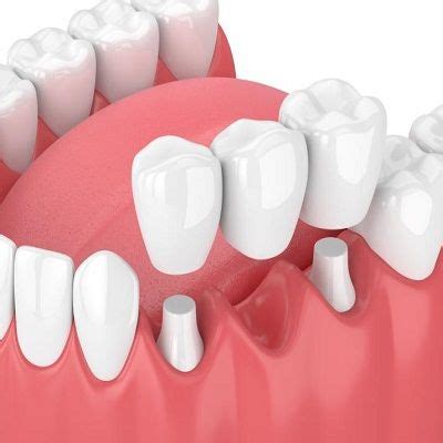 How long does tooth sensitivity last after crown in Dubai, Abu Dhabi & Sharjah