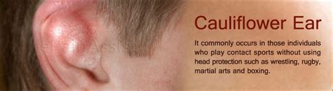 Cauliflower Ear or Hematoma Auris: Treatment, Causes, Symptoms