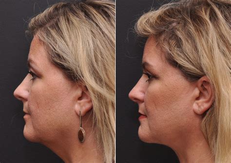 Facial Liposuction Photos | Cincinnati, OH | Patient 8345