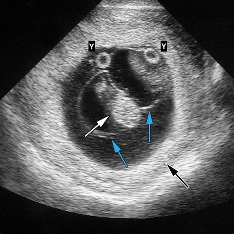 Top 92+ Pictures Amnion And Chorion Not Fused At 17 Weeks Excellent