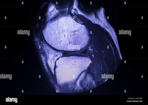 Magnetic resonance imaging MRI knee posterior horn medial meniscus tear scantest results Stock ...