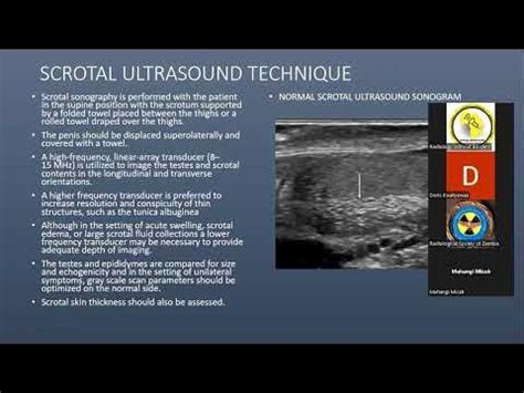 Ultrasound Diagnostic Dilemma: Testicular Torsion Vs Epididymo-orchitis ...