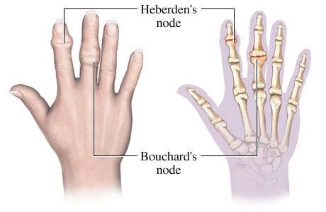 DIP and PIP Joint Arthritis - Hand - Orthobullets