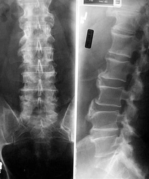 Diffuse idiopathic skeletal hyperostosis | Norway | PDF | PPT| Case Reports | Symptoms | Treatment