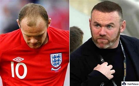 Wayne Rooney Hair Transplant | Success or Failure?