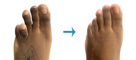 Before And After Foot Surgery - Image Gallery | London Foot & Ankle Surgery