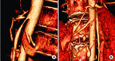 (A) Near-total occlusion of the celiac trunk and severe stenosis of the ...