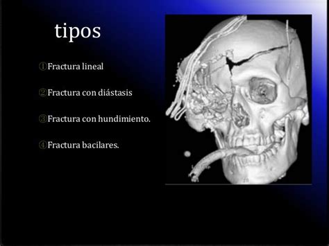 Fracturas de craneo