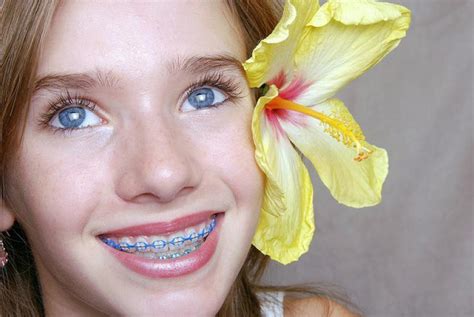 Braces for kids – Types, Benefits and Prevention of Tooth Decay - ViewKick