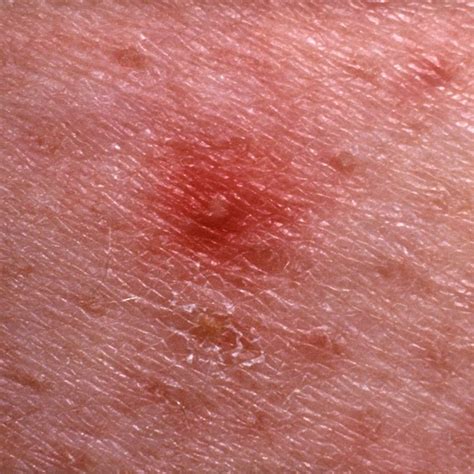 12 Bumps On Your Skin That Are Totally Normal—And You Shouldn't Pop ...