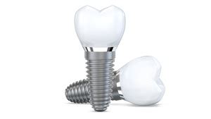 Titanium Dental Implants Reynoldsburg | Mick Family Dental Care