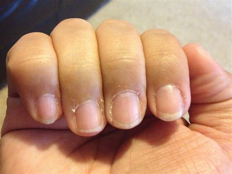 Dry fingernails with ridges - Awesome Nail