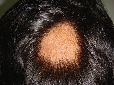 Alopecia Areata Treatment Cream