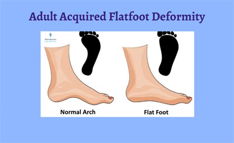 Adult Acquired Flatfoot Deformity, Causes and Treatment | Dubai, UAE | Westminster Ortho Med ...