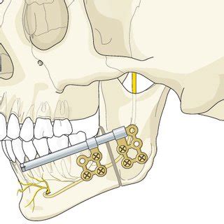 Distraction Osteogenesis procedure [31] | Download High-Resolution Scientific Diagram