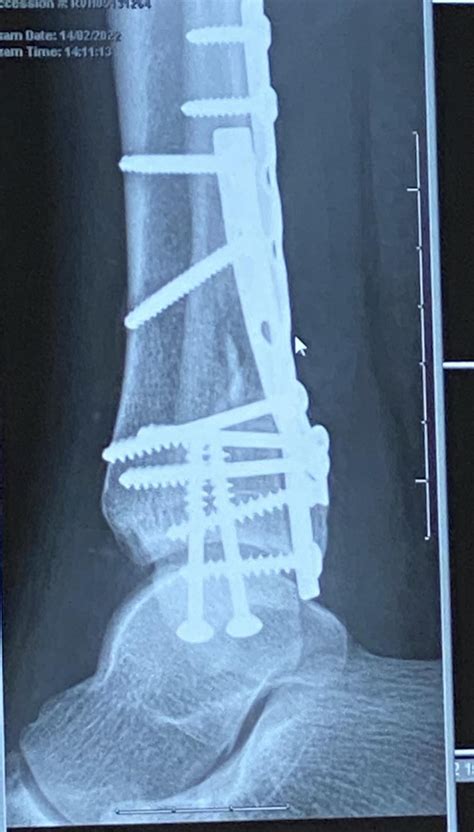 My ankle surgery : r/brokenbones