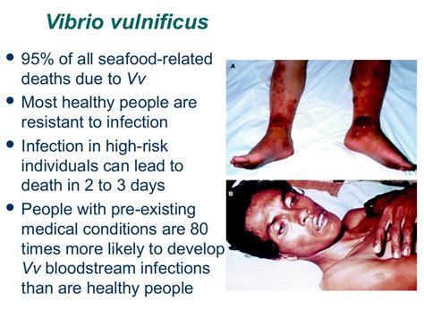 Vibrio vulnificus