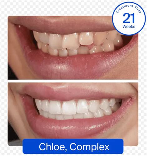 Smile White Aligners Before and After: Compare Real Treatment Results