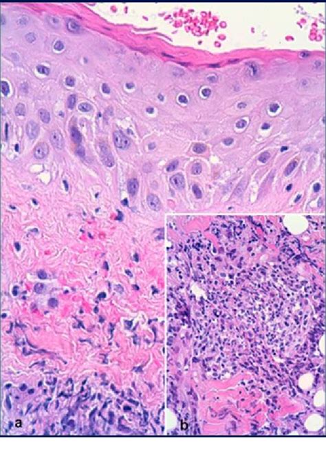 Figure 2 from Kikuchi disease with skin lesions mimicking lupus erythematosus. | Semantic Scholar