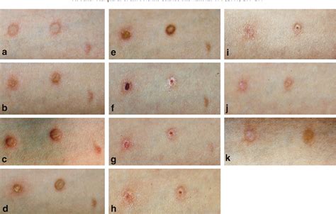 Figure 2 from Cigarette burns in forensic medicine. | Semantic Scholar