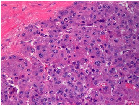 Diagnostics | Free Full-Text | Hepatocellular Carcinoma, Fibrolamellar ...