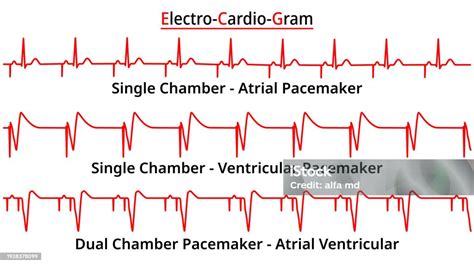 Set Of Ecg Common Abnormalities Single Vs Dual Chamber Pacemaker Atrial Ventricular Rhythm Stock ...