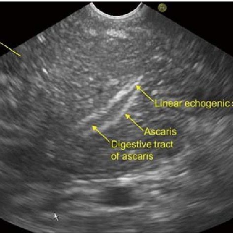 Ascaris Ultrasound