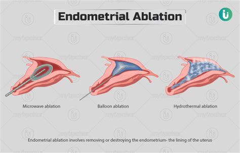 Post Endometrial Ablation Weight Gain | Blog Dandk