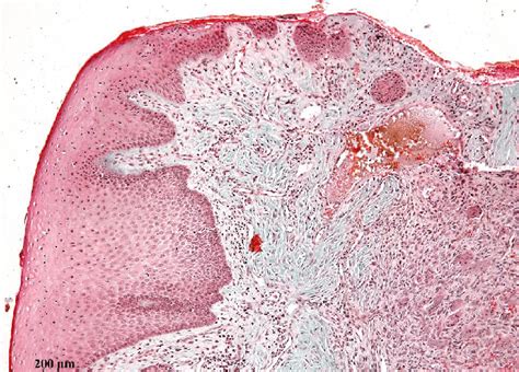 Hemosiderin deposition could be seen in the areas of old hemorrhage.... | Download Scientific ...