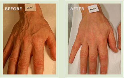 Hand Veins – The Vein Treatment Center