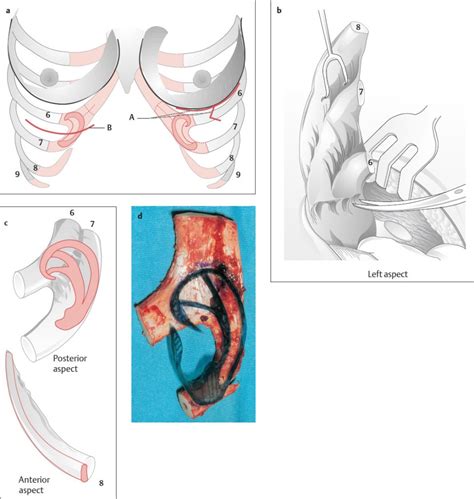 Rib Cartilage | Plastic Surgery Key