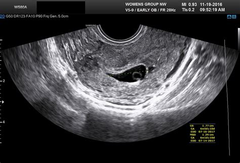 Diagnostic Ultrasound In The First Trimester Of Pregnancy GLOWM 34776 | Hot Sex Picture