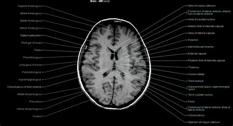 Brain MRI - NeurologyNeeds.com | Brain, Mri, Internal capsule