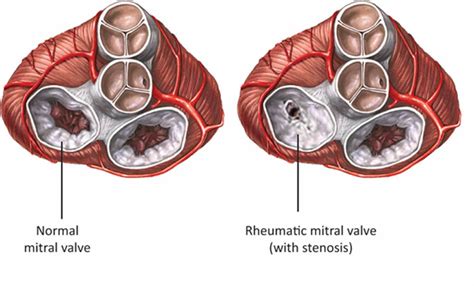 Rheumatic Heart Disease - Causes, Symptoms, Treatment & Prevention