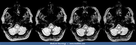 Superficial siderosis | MedLink Neurology