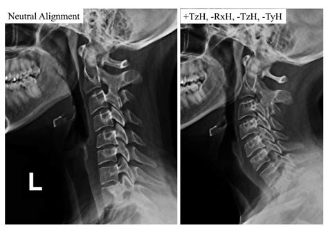 JCM | Free Full-Text | A Comparison of Two Forward Head Posture ...