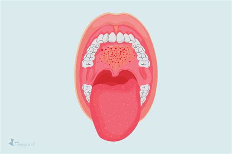 COVID-19 Might Cause Mouth Lesions, New Study Suggests