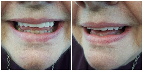 Partial Upper Denture | Kelowna Denture Clinic