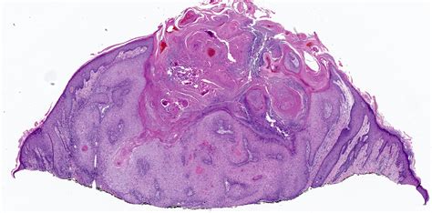 Keratoacanthoma Histology