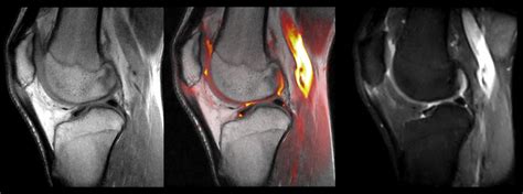 A Thermographic Evaluation of Patellar Tendon Partial Tear | coachingultrasound