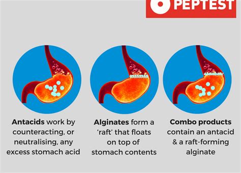 Alginate antacids for treating reflux: a medication comparison study