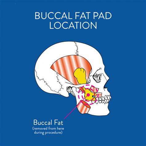 Buccal Fat Pad Reduction Procedure in Washington DC | Cheek Reduction