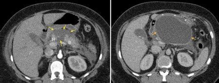 Pancreatic pseudocyst - Radiology at St. Vincent's University Hospital