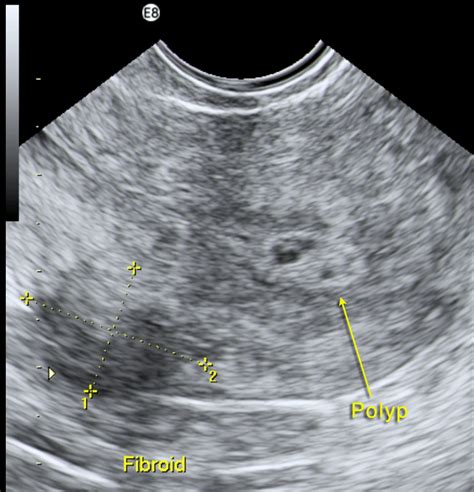 Uterine Polyps