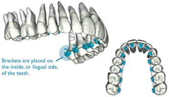 SureSmile® Lingual - Kierl Orthodontics | Edmond OK