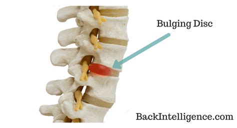 Bulging Disc Exercises In Lower Back - Do These At Home