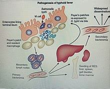 Typhoid Fever